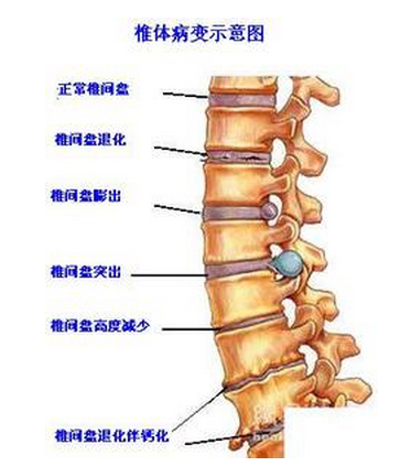 腰椎骨质增生用什么方法治疗