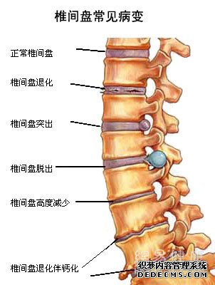 腰椎间盘突出