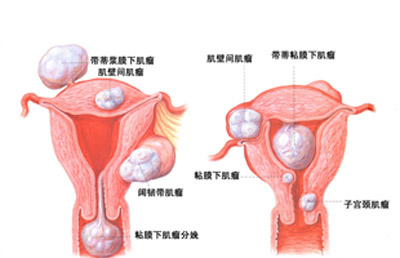 子宫肌瘤的症状