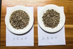 两大碟“砂子”!20年“拖”出罕见肾结石