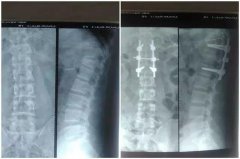 千斤钢棚“砸断腰”,两次手术23天走起!