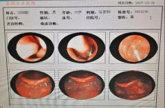 他鼻子呈S型弯了五年，如今“掰直”竟然这么容易？！