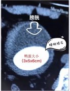 六旬老汉把石头养成鸭蛋大,医生惊呆了
